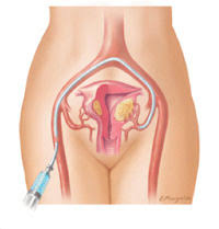 Embolização uterina é a esperança no tratamento de miomas