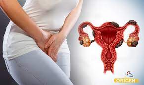 Endometriose: o que é e como tratar