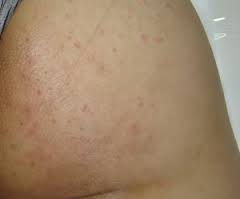 Foliculite causa irritação e mancha a pele