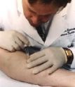 Técnica pouco popular no Brasil trata varizes sem cirurgia