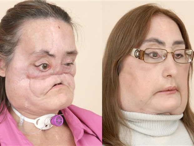 Mulher que recebeu transplante de rosto defende doação de órgãos